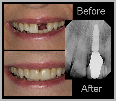 Dental Implants
